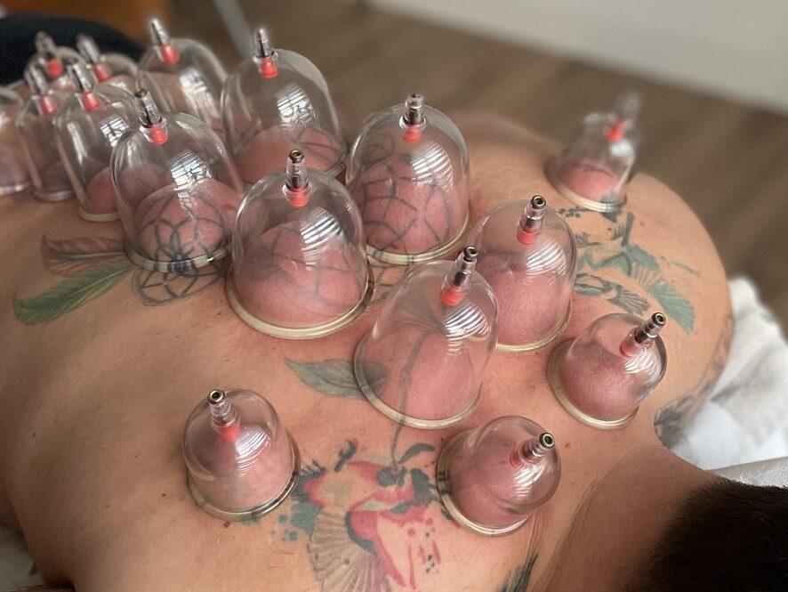 cupping therapy